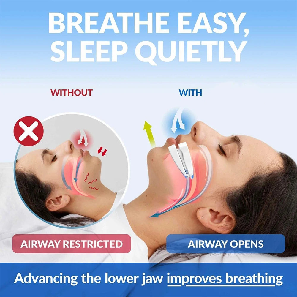 SilentNight Anti-Snoring Mouth Guard – Quiet Sleep Mouthpiece